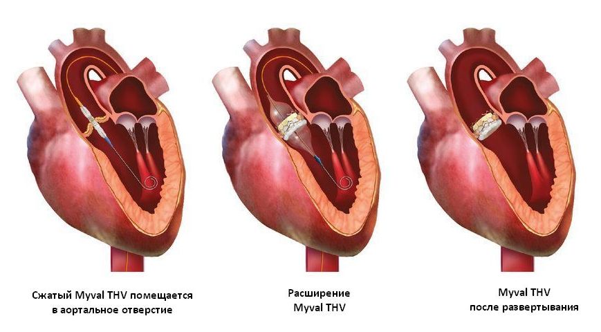 TAVR Procedure ru