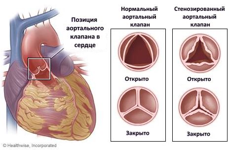 tavr01r